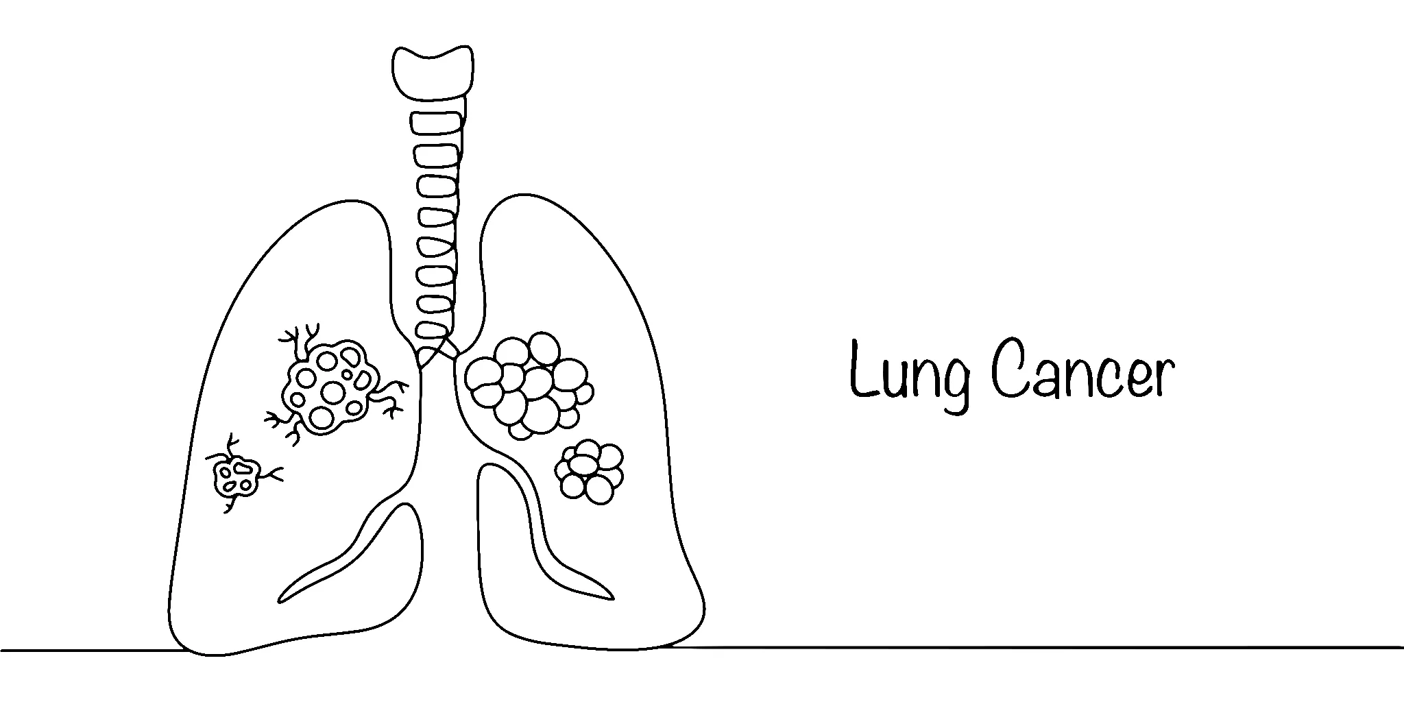 Pulmonary cancer metastasis-image
